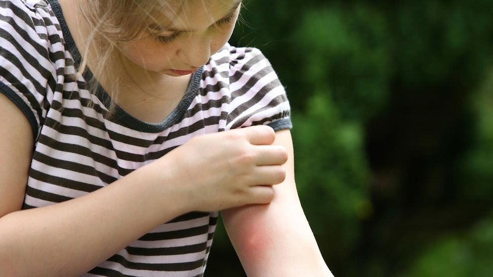 Home Cures for Mosquito Bite Itch 01