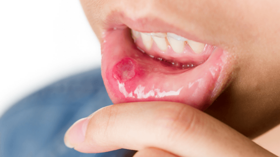 Home Remedies for Canker Sores
