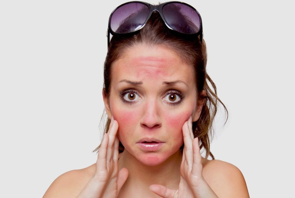 Home remedies for sunburn face