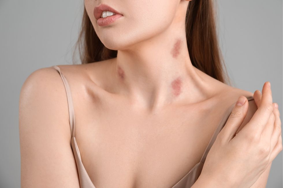 how to get rid of hickeys 1599747442