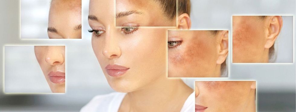 hyperpigmentation treatments that w
