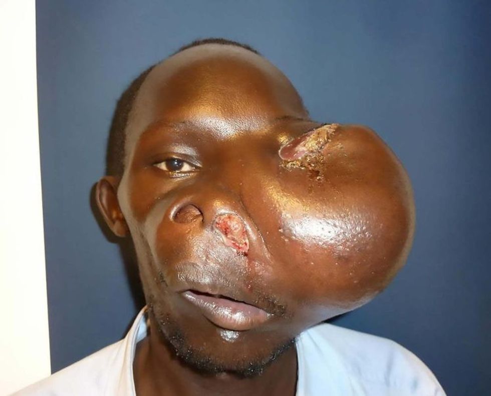 i-hiqet-tumori-gjigant-qe-i-kishte-perfshire-tere-fytyren-foto-2