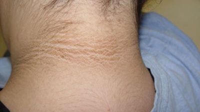 2016/05/Acanthosis-Nigrica_2640754a.jpg