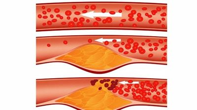 2016/06/Clean-your-clogged-arteries-and-eliminate-bad-cholesterol-with-this-natural-remedy-1024x545.jpg