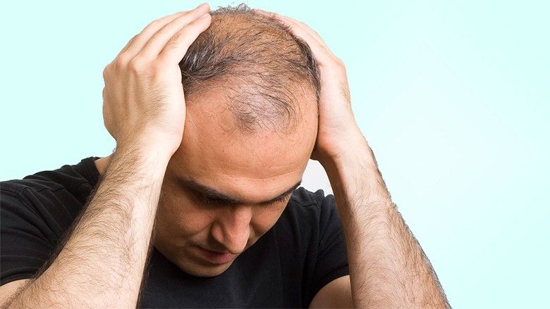 2014/11/hair-loss-men.jpg