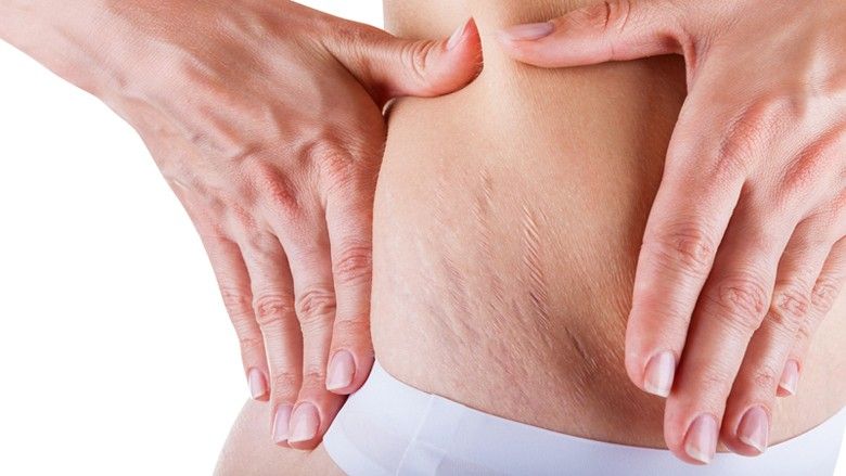 2019/01/Home-Remedies-To-Get-Rid-Of-Stretch-Marks1.jpg