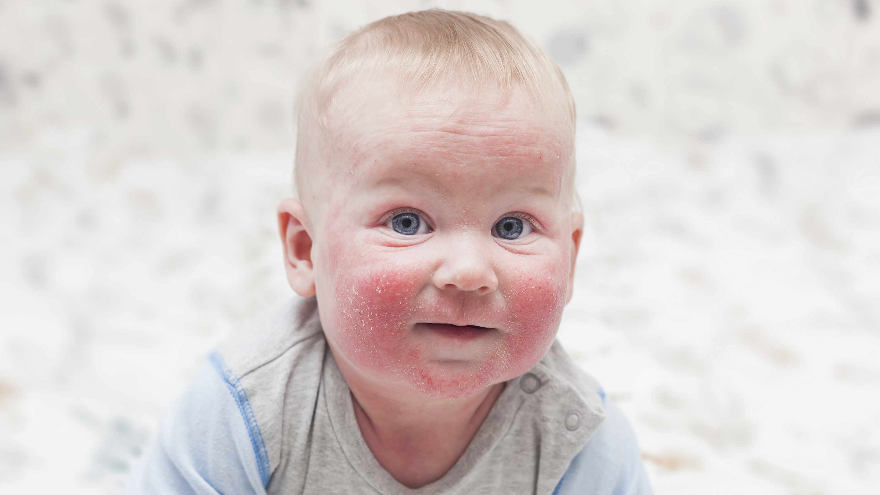 2019/03/baby-with-red-chapped-cheeks-eczema-dermatitis-16x9.jpg