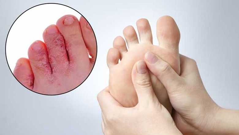 2020/02/Home-Remedies-for-Athlete-Foot.jpg