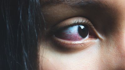 2020/03/eye-pain-red-bloodshot-1200x628-facebook.jpg