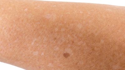 2021/07/white-spots-on-skin-from-sun.jpg