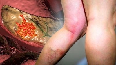 2021/11/pancreatic-cancer-the-warning-sign-in-your-legs-of-common-disease.jpg