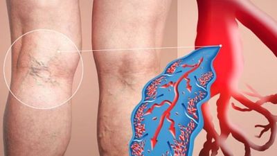 2021/11/Deep-vein-thrombosis-symptoms-Six-early-stage-signs-in-your.jpg