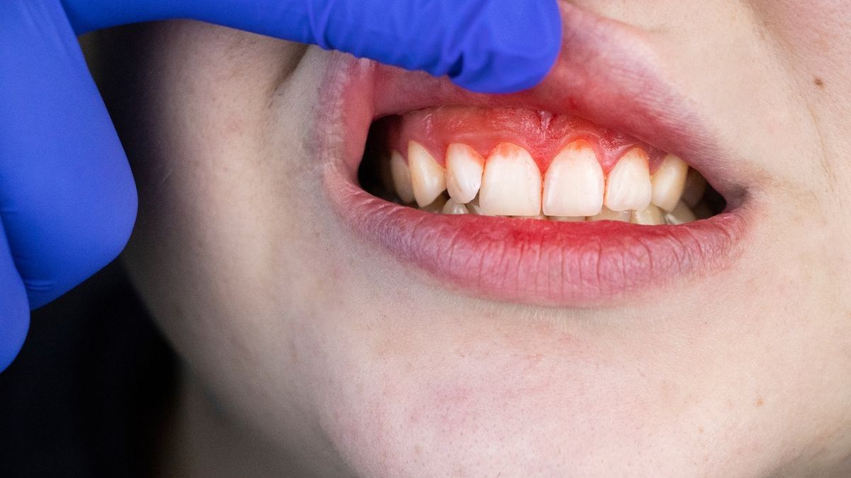2021/12/0_Gum-bleeding-and-inflammation-close-up-A-man-examined-by-a-dentist-The-diagnosis-of-gingivitis.jpg