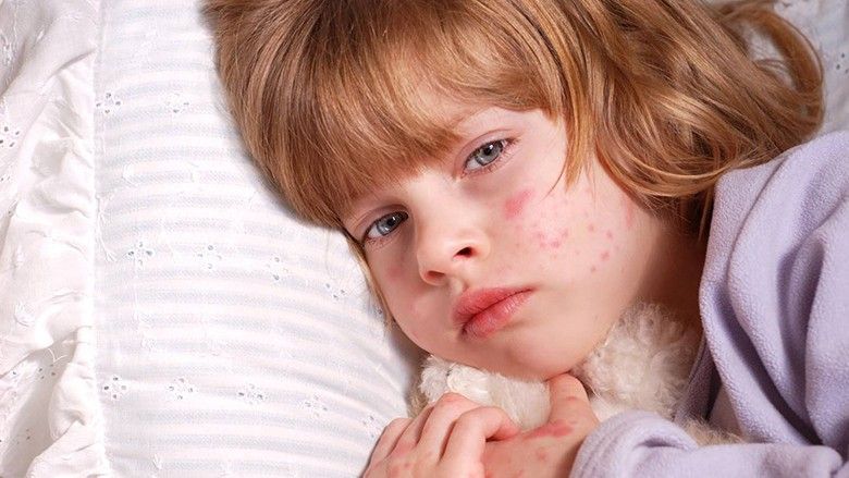 2022/03/Does-my-child-need-treatment-for-their-rash.jpg
