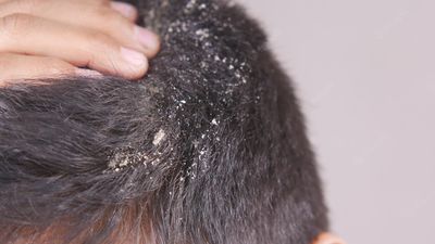 2022/08/men-with-dandruff-his-hair-closeup_260672-10042.jpg