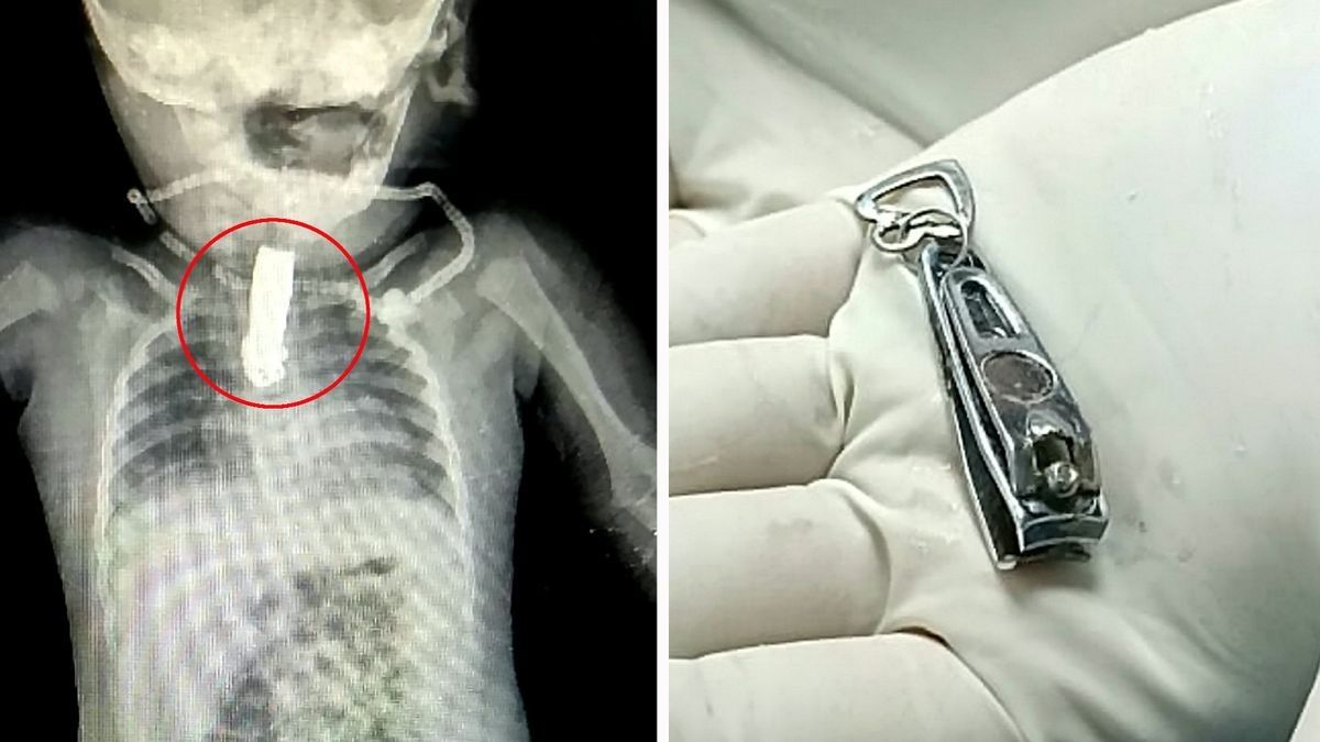 2022/09/0_SWNS_SWALLOWED_NAILCLIPPER_009.jpg
