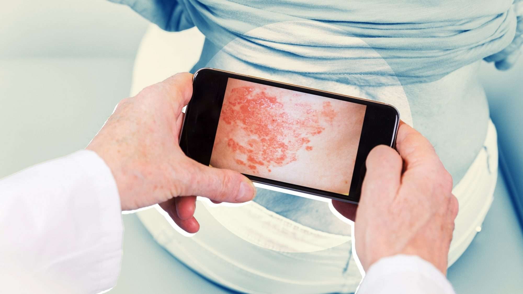 2023/02/Psoriasis-Causes-GettyImages-1041955150-2000-7548fbfdf34b472896f3f2e0ea0123ad.jpg