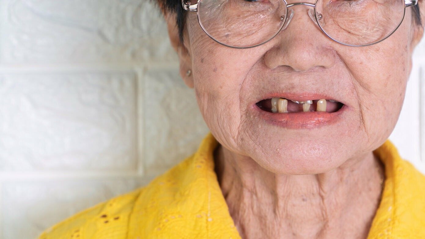 2024/10/tooth-loss-edentulism-aging-gerosciencie-2.jpg