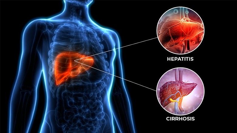2024/11/WhatsthedifferencebetweenHepatitisandCirrhosis-.jpg