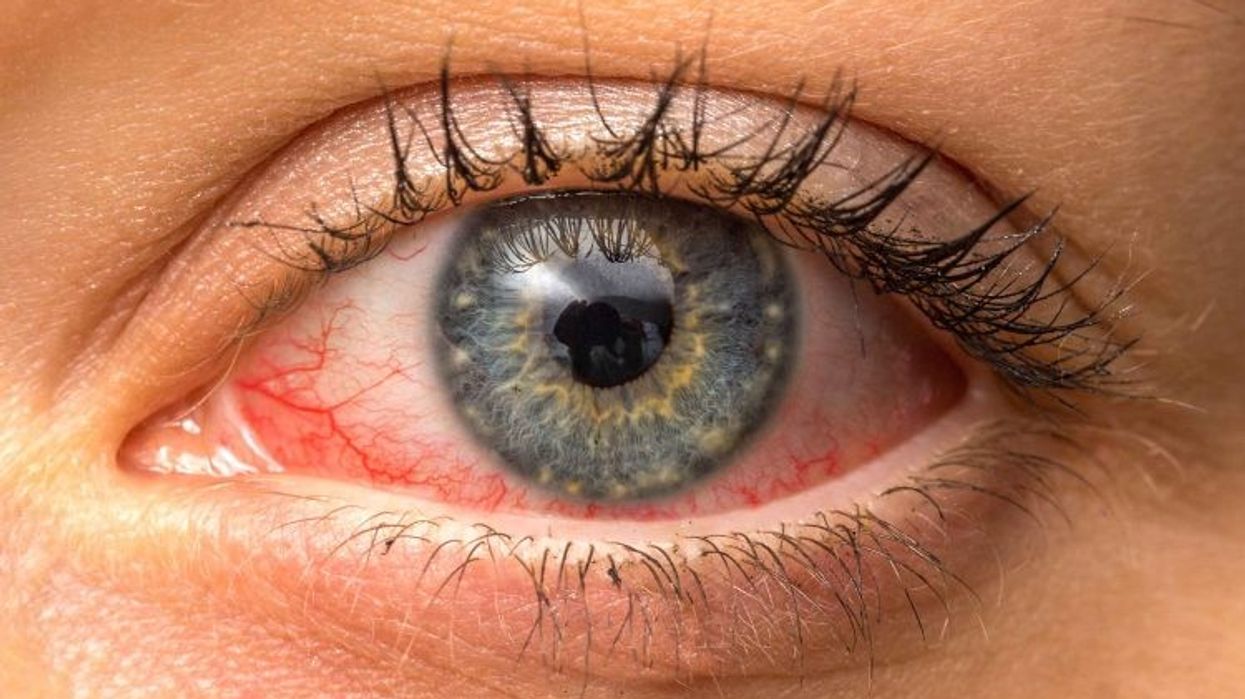 Java e glaukomës - kontroll falas për tensionin e syrit