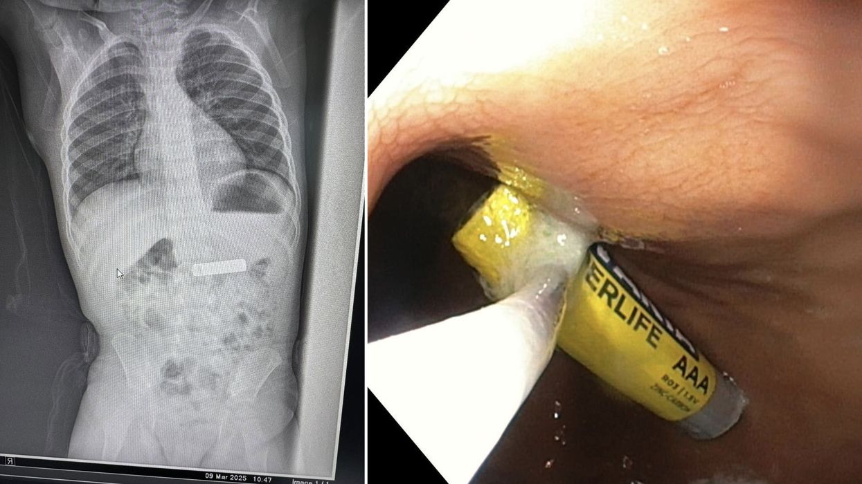 Gastroenterologu në Gjilan ia largon dyvjeçarit baterinë e telekomandës nga stomaku