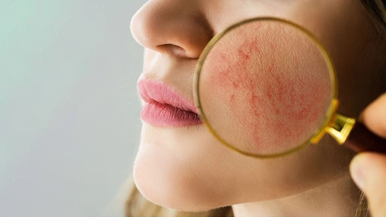 Dy mënyra si të përballeni me kapilarët e pëlcitur: Recetë e konfirmuar shtëpiake!