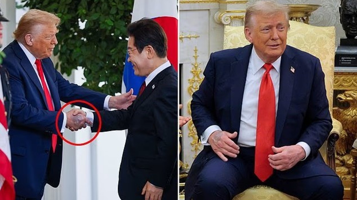 Shqetësimet për shëndetin e Donald Trump shtohen, ndërsa presidenti 79-vjeçar shihet me një tjetër mavijosje në duar