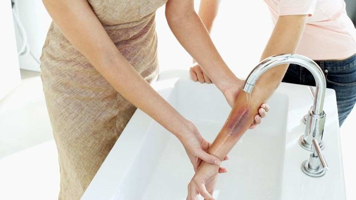 Mos vendosni kurrë akull apo vaj mbi djegie – ja çfarë thonë mjekët