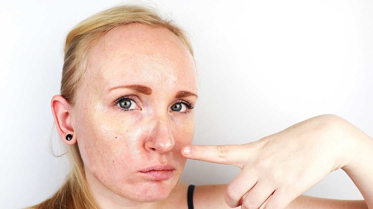 Lëkurë e yndyrshme dhe shkëlqim i tepërt? Ja si ta riktheni balancën natyrale