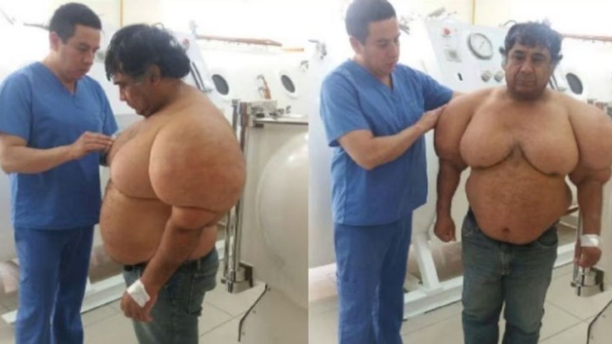 Aksident i çuditshëm në zhytje bën që trupi i peruanit të fryhet - mjekët nuk e dinin se si ta rregullojnë