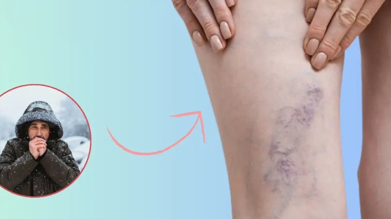 Si ndikojnë të ftohtit dhe kushtet atmosferike në venat dhe cilat simptoma kërkojnë reagim urgjent