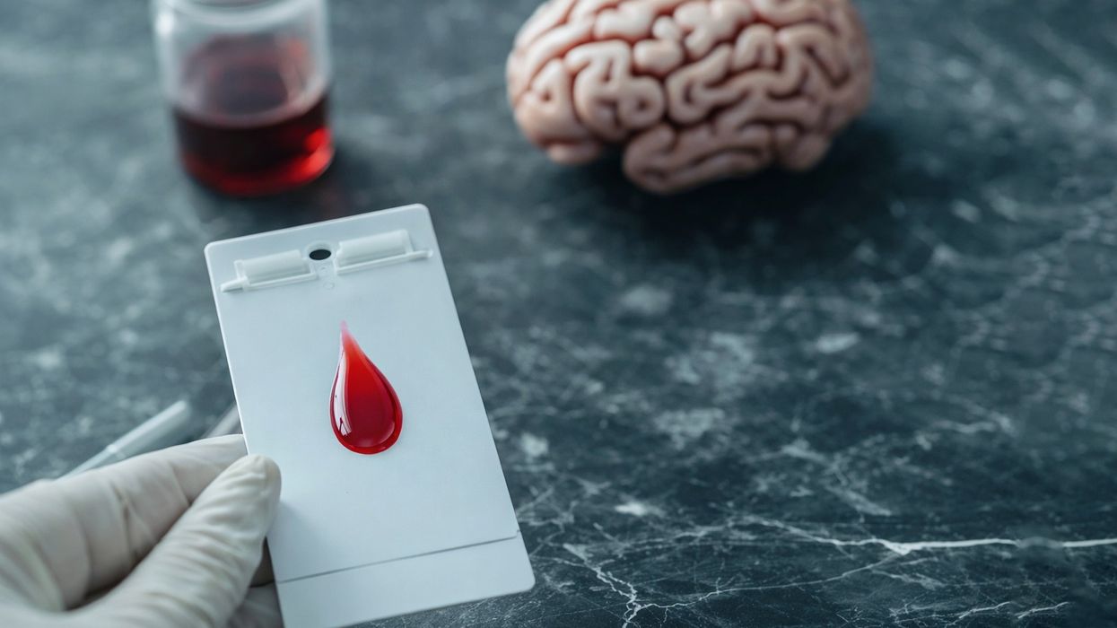 Testi i gjakut mund të diagnostikojë Alzheimerin: Studim i ri po hulumton testet me shpim gishti Testi i gjakut mund të diagnostikojë Alzheimerin: Studim i ri po hulumton testet me shpim gishti