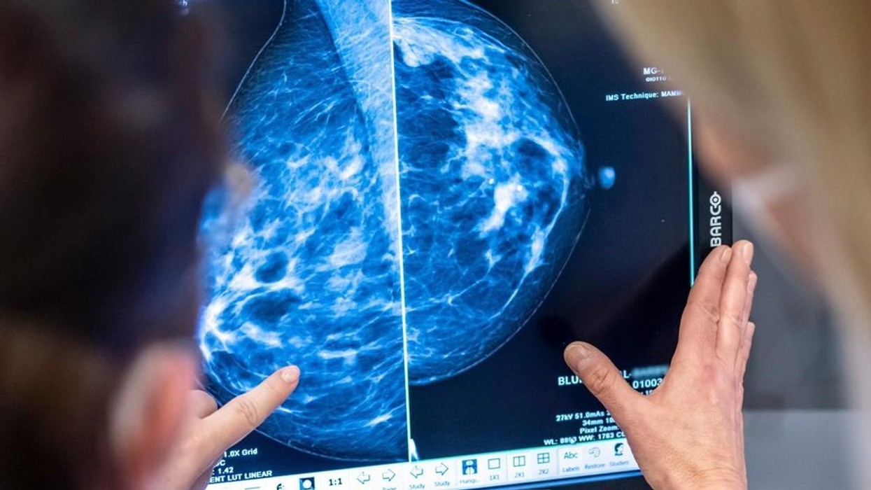 Pothuajse çdo person i dytë në Gjermani do të përballet me kancer në një moment të jetës së tij - studimi i RKI tregon katër llojet më të zakonshme të tumoreve