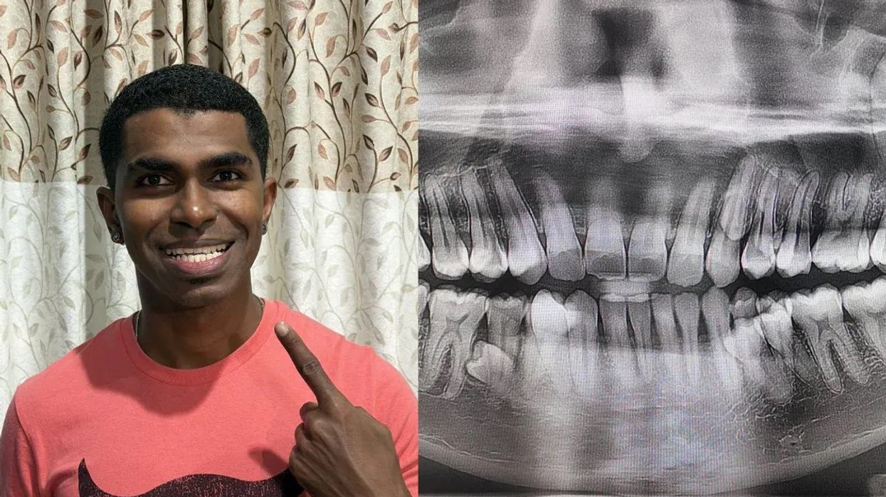 Rekord botëror - burri nga Malajzia ka 42 dhëmbë