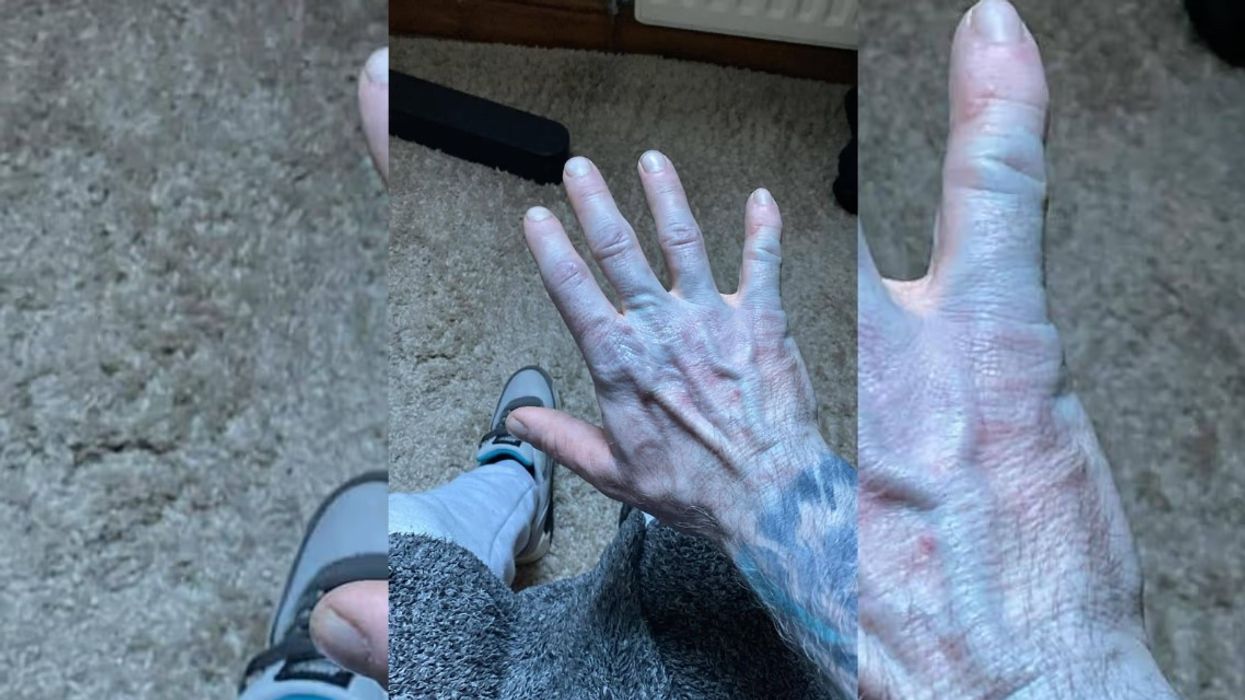 Britaniku kur u zgjua nga gjumi ishte i tëri i kaltër, shkoi me urgjencë në spital – atje mjekët zbuluan të vërtetën që i bëri të qeshin Britaniku kur u zgjua nga gjumi ishte i tëri i kaltër, shkoi me urgjencë në spital – atje mjekët zbuluan të vërtetën që i bëri të qeshin