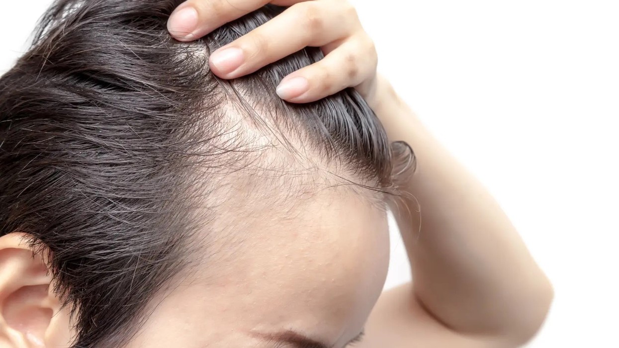 Trajtimi i ri “3 në 1” kundër rënies së flokëve mund të jetë më efektiv se finasteridi dhe minoxidili