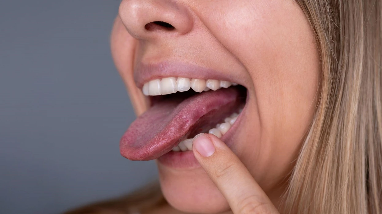 A keni gjuhë me gjurmë anash? Mund të tregojë probleme me vitaminat, tiroiden ose gjumin