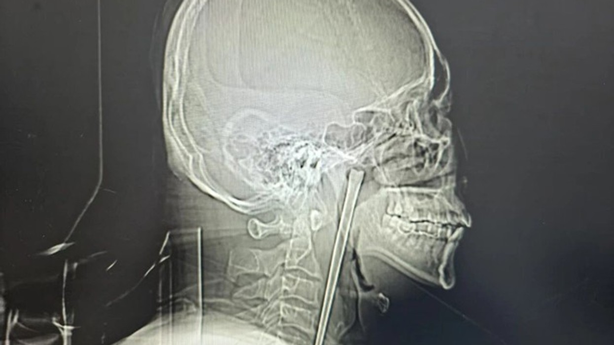 Kinezi jeton tetë vite me shkop metalik të ngecur në fyt