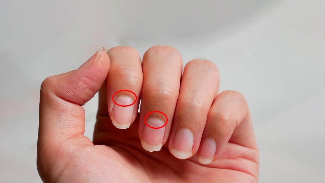 Nëse ju zhduken këto gjysmëhëna në thonj, mund të jetë shenjë e hershme e sëmundjes