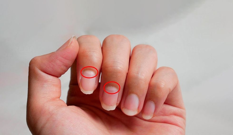 Nëse ju zhduken këto gjysmëhëna në thonj, mund të jetë shenjë e hershme e sëmundjes