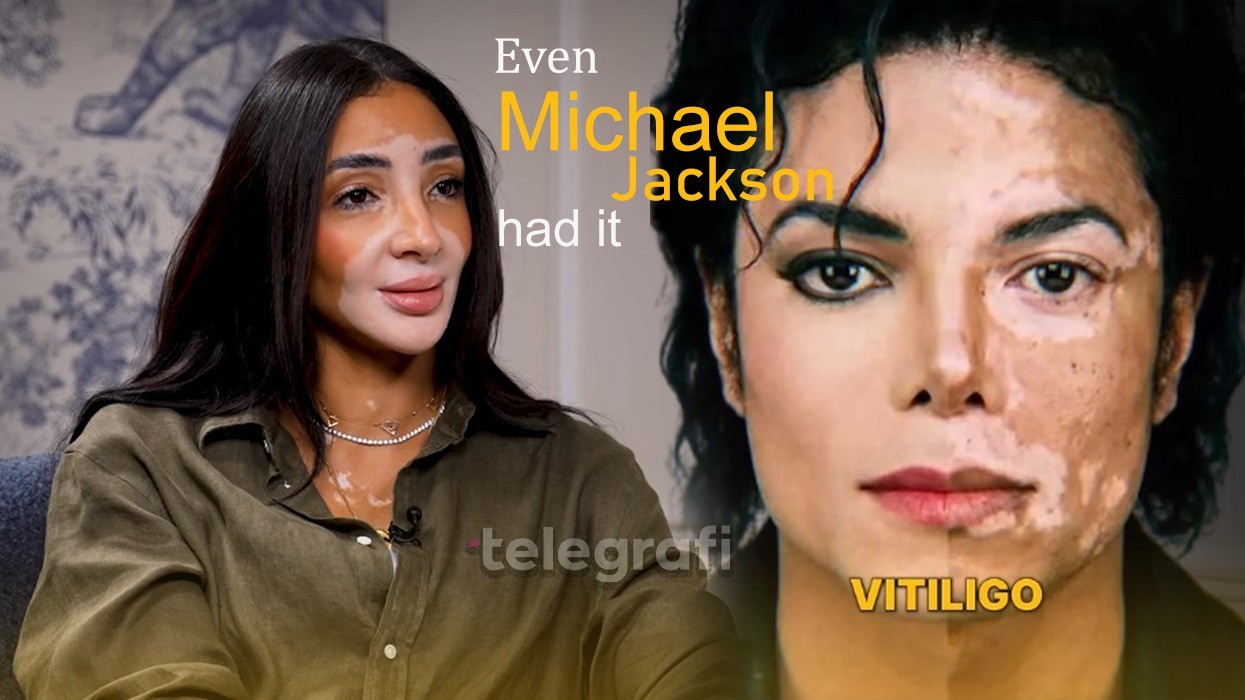 Miss Universe 2024 ngre zërin për vitiligon, merr shembull Michael Jackson: Njerëzit e keqkuptuan, ishte shumë e dhimbshme