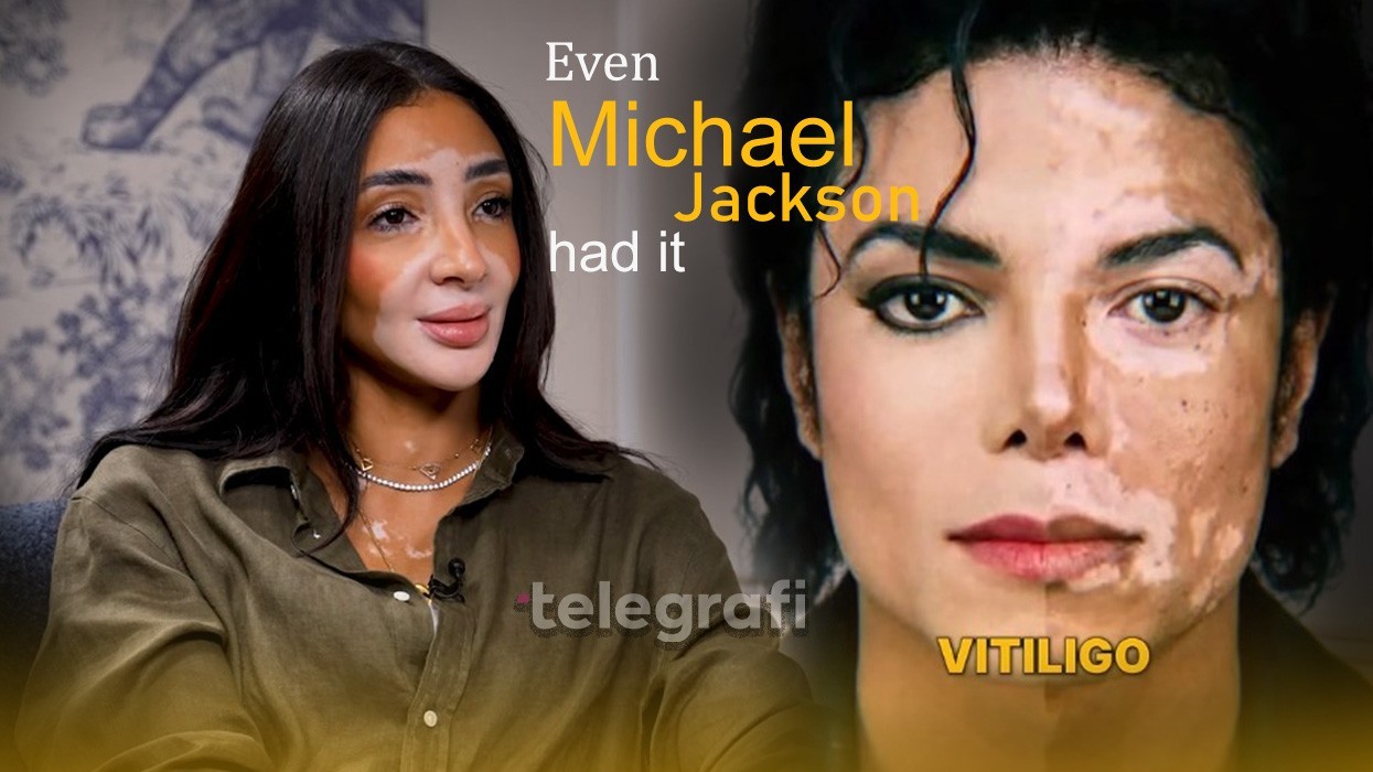 Modelja Logina Salah ngre zërin për vitiligon, merr shembull Michael Jackson: Njerëzit e keqkuptuan, ishte shumë e dhimbshme