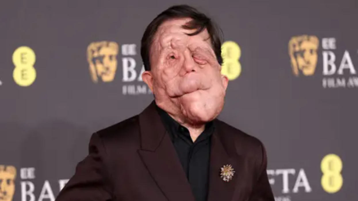 Adam Pearson u bë viktimë e fyerjeve të tmerrshme për shkak të pamjes së tij