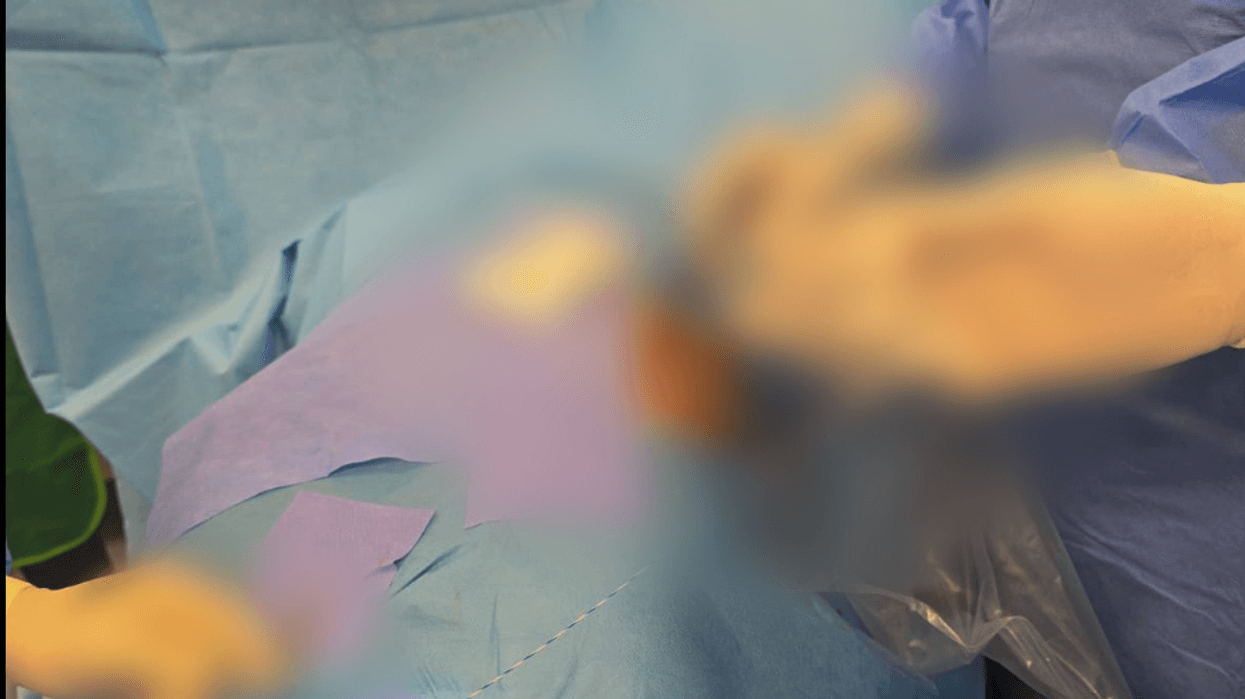 Për herë të parë në Kosovë realizohet ndërhyrja kirurgjikale minimal invazive PCNL për trajtimin e gurëve të mëdhenj në veshka