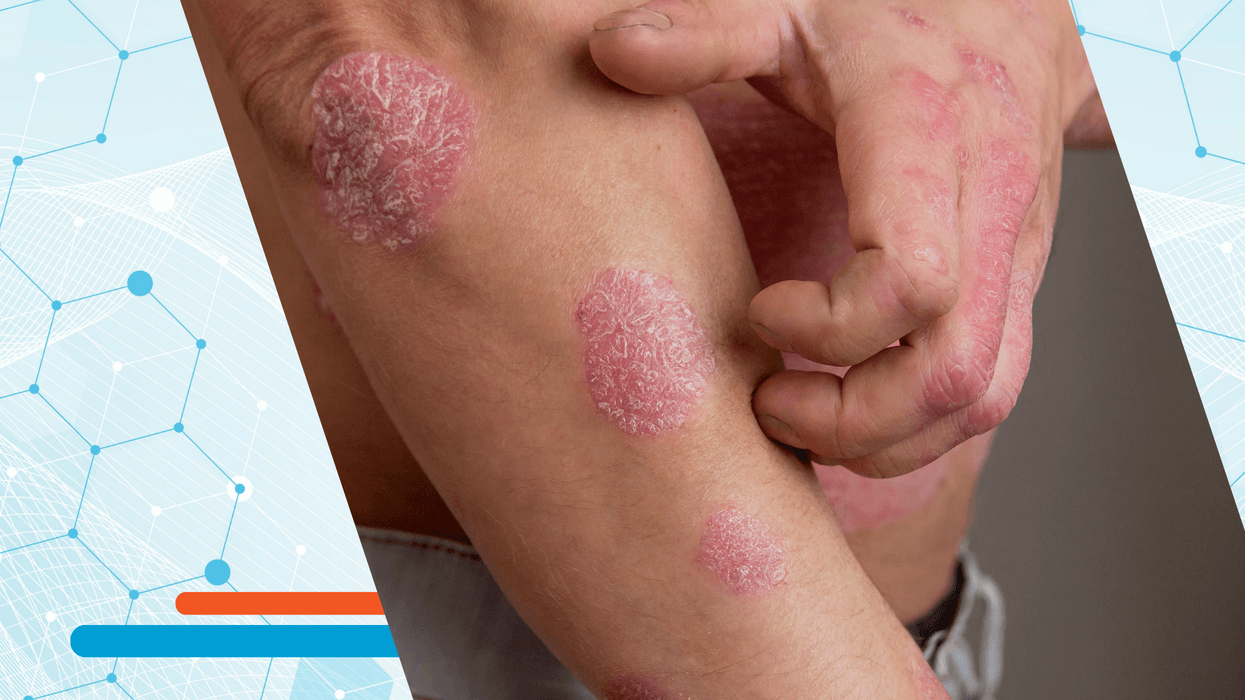 Ilaçi i parë oral për psoriazën sjell shpresë të re Ilaçi i parë oral për psoriazën sjell shpresë të re