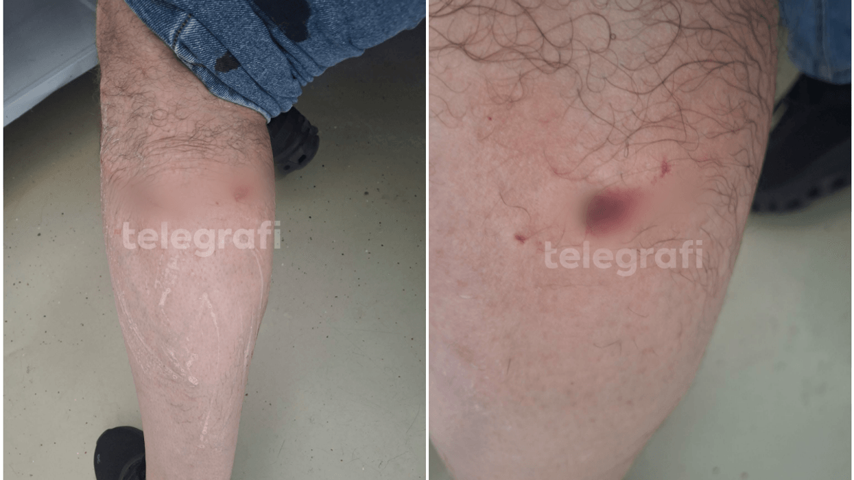 Tjetër sulm i qenve endacakë në Prishtinë, një qytetar përfundon në QKUK - a po pret kryeqyteti për tragjedi që të intervenohet?