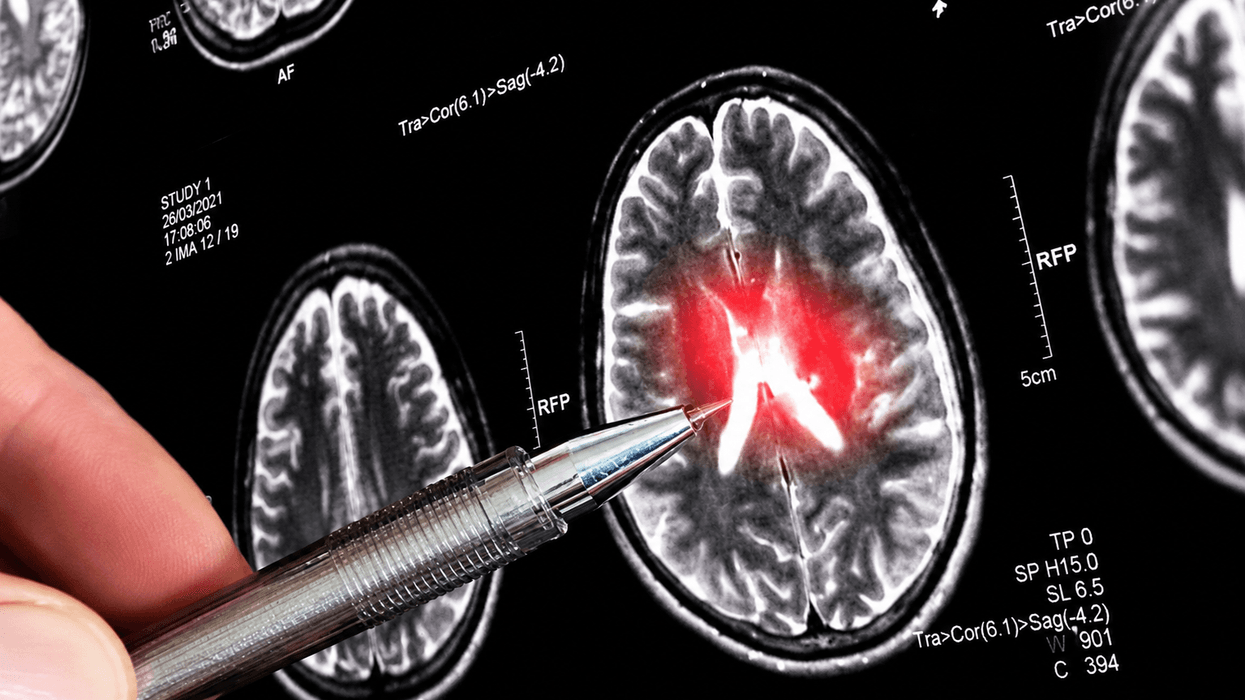Tumori i trurit tani mund të zbulohet për 12 minuta: AI sjell kthesë në neuroonkologji