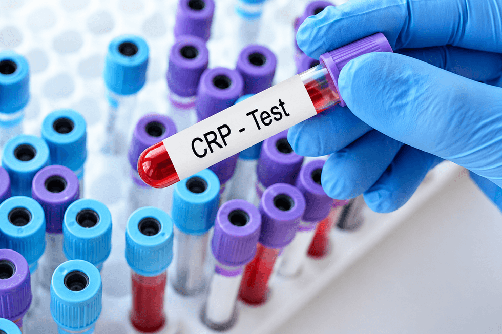 Proteina C-reaktive: A duhet ta bëjnë edhe të shëndetshmit këtë analizë të gjakut?