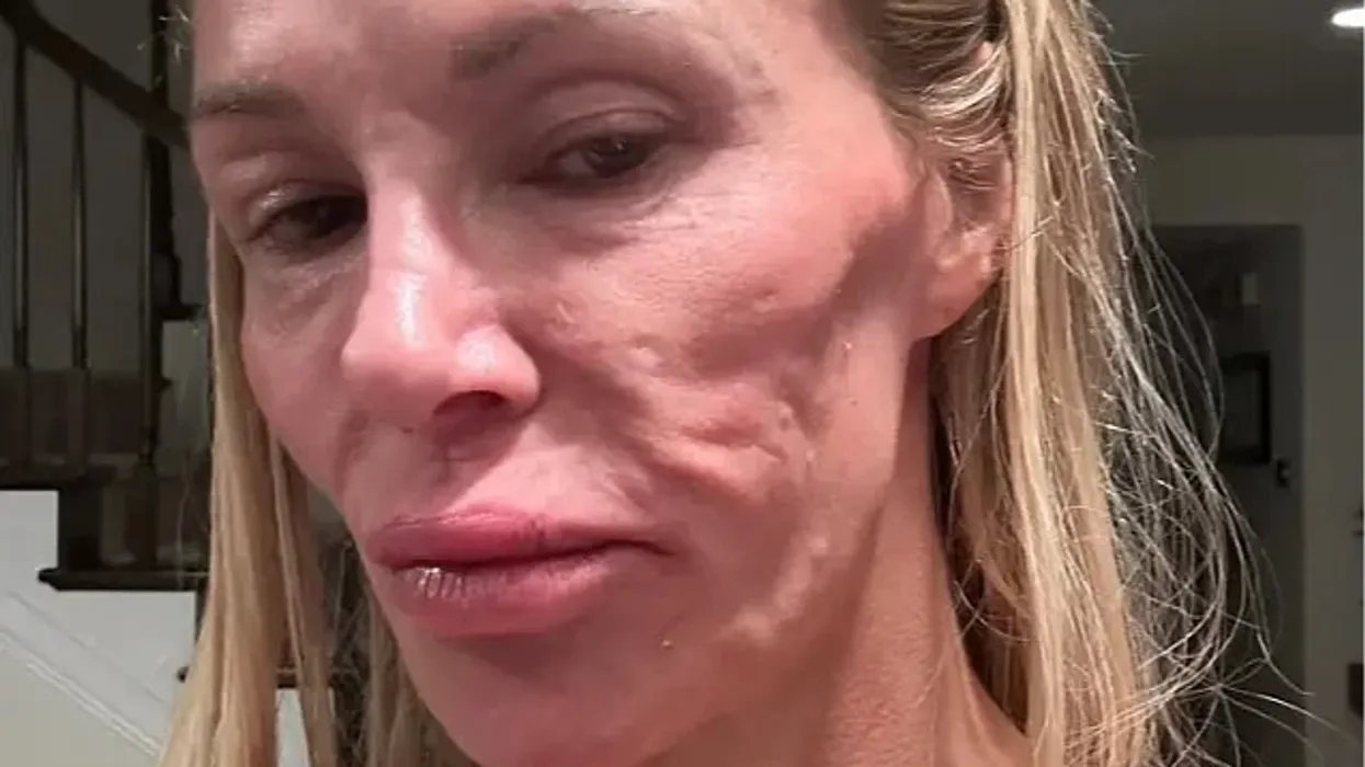 Ish-modelja zbuloi se fytyra e saj ishte shpërfytyruar sepse implantet e gjoksit i shpërthyen: Kisha një parazit Ish-modelja zbuloi se fytyra e saj ishte shpërfytyruar sepse implantet e gjoksit i shpërthyen: Kisha një parazit