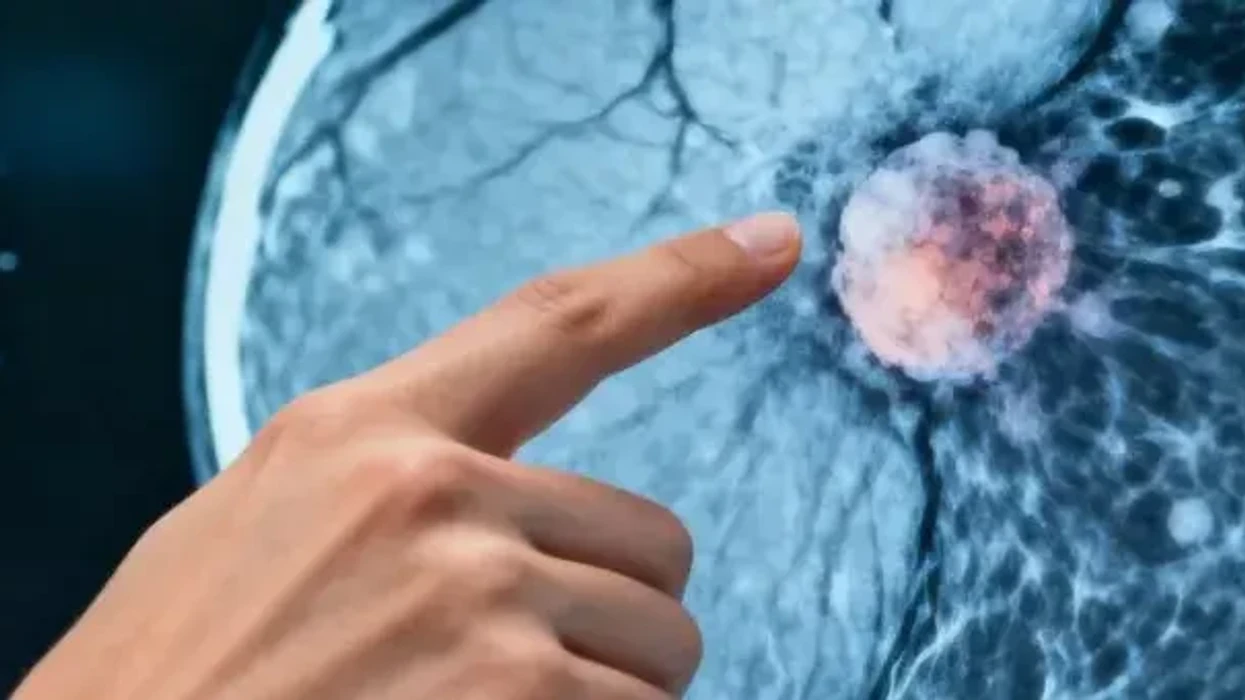 Kjo nyje limfatike zbulon e para nëse kanceri po përhapet